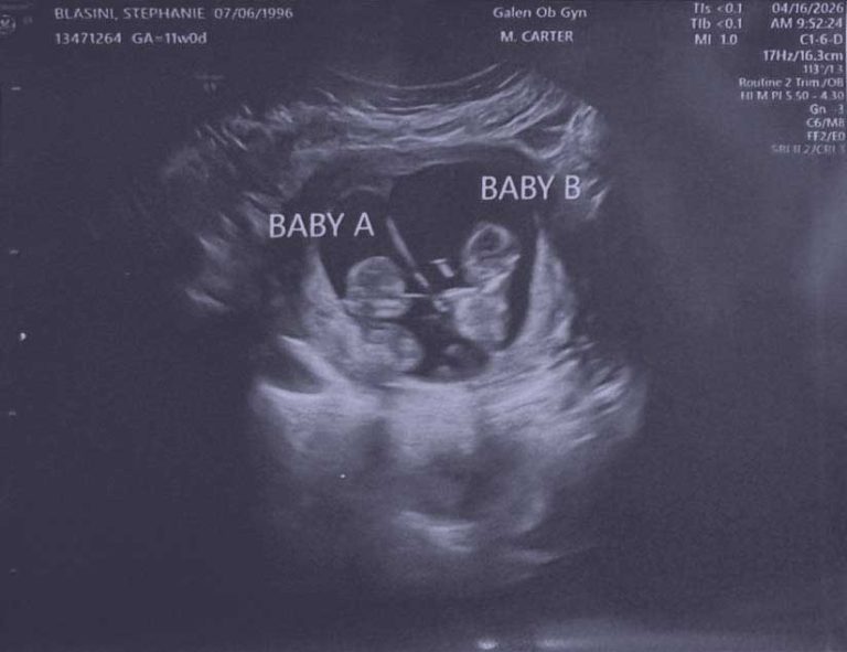 Baby Sonogram for Kailani & Koalani