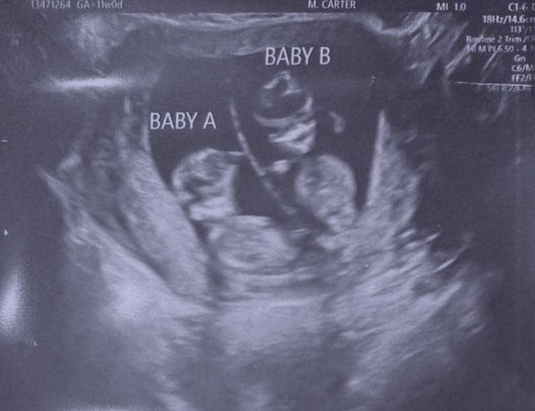 Baby Sonogram for Kailani & Koalani