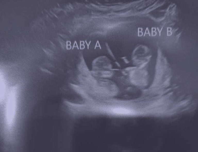 Baby Sonogram for Kailani & Koalani